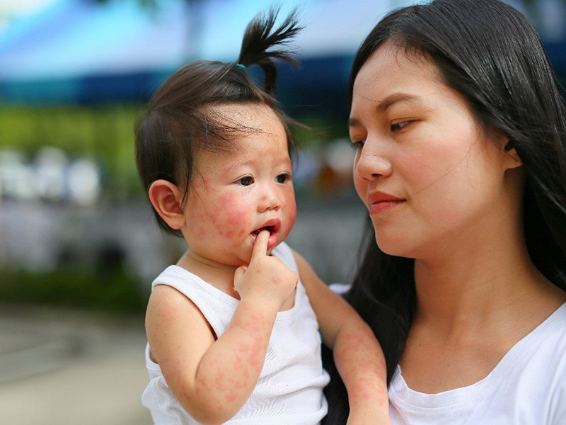 Bệnh tay chân miệng ở trẻ em đa phần là lành tính. 