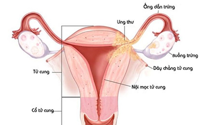 Ở căn bệnh này, lớp niêm mạc tử cung mọc ra ngoài tử cung.