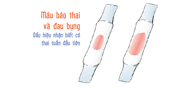 Chảy máu âm đạo- dấu hiệu mang thai.