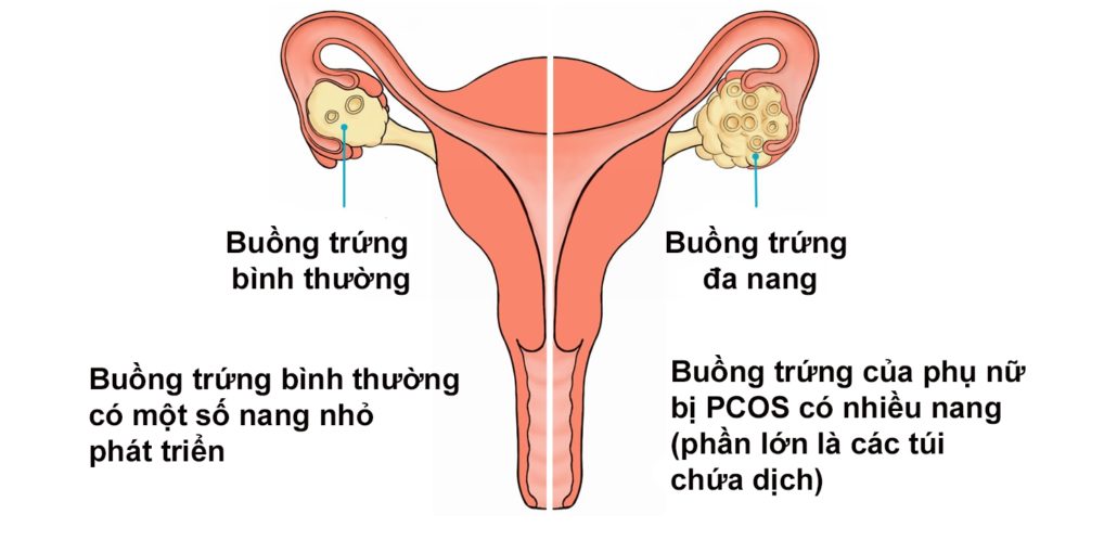 Bệnh này dễ dẫn đến tình trạng vô sinh ở nữ giới không được phát hiện và điều trị kịp thời.