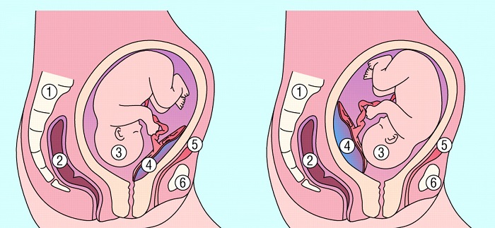 Nhau tiền đạo chính là trường hợp bánh nhau bám ở đoạn dưới cổ tử cung, lúc này nó sẽ che một phần hoặc che khuất cổ tử cung