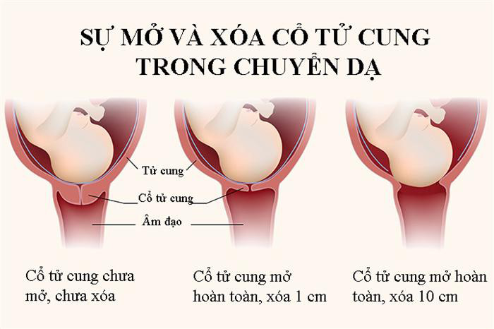 Mẹ sẽ bắt đầu xuất hiện những cơn đau thắt dữ dội do tử cung bắt đầu giãn nở.