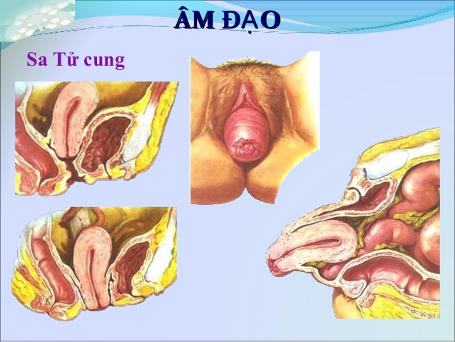 Trước khi tìm hiểu sa tử cung có nguy hiểm không, hãy cùng tham khảo sa tử cung là gì?