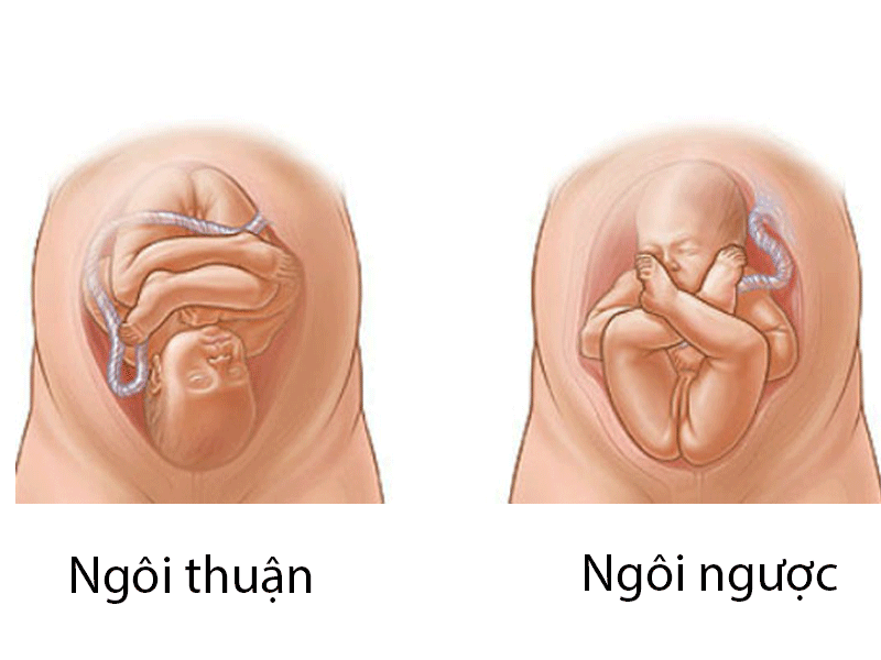 Thai 30 tuần ngôi ngược có mông xoay về phía cổ tử cung