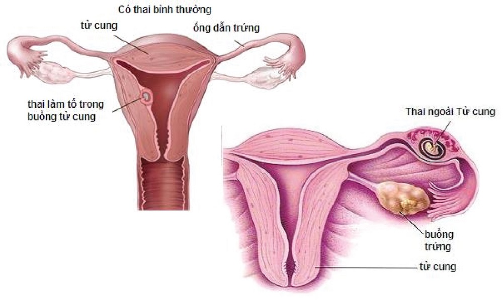 Thai ngoài tử cung vô cùng nguy hiểm cho người mẹ