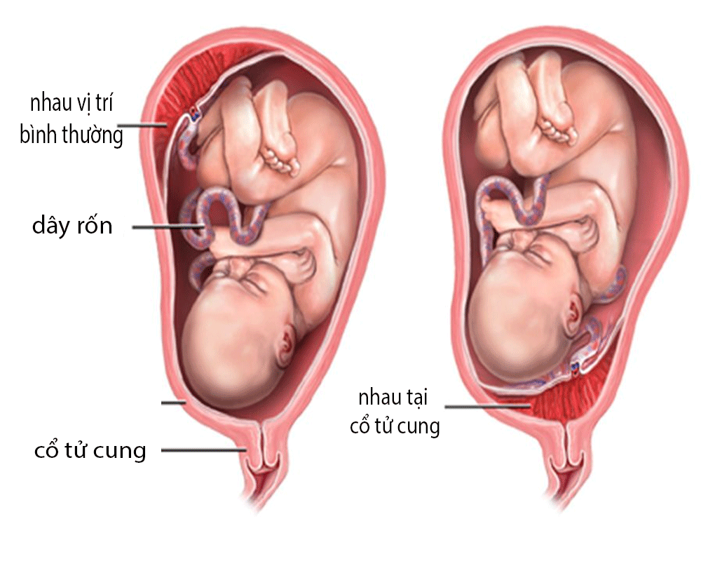 Nạo nhau thai ở cổ tử cung có thể gây băng huyết