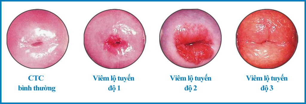 viêm lộ tuyến tử cung có sinh thường được không?